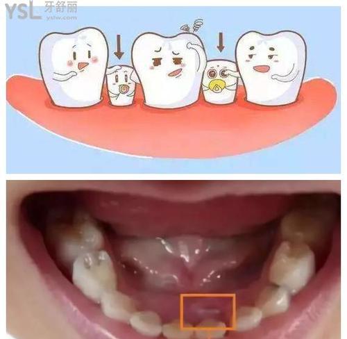 儿童大牙更替时机与口腔保健方法全解析