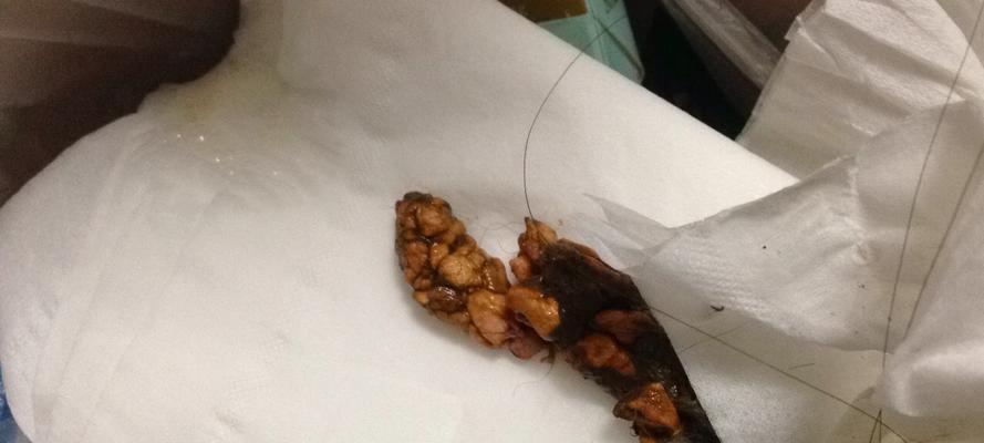 细小早期患者大便异常症状解析及就医指导