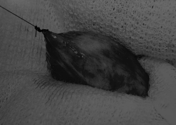 膀胱切开术操作步骤详解及注意事项要点