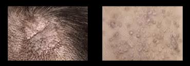 皮肤病为什么难治愈？15大原因分析及解决方案