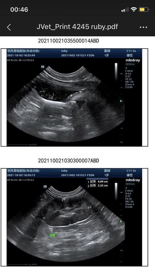 膀胱结晶的成因症状与治疗方法详解